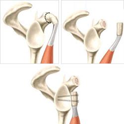 Latarjet procedure Afsteun anterieur Sling effect biceps Atraumatic / multidirectionele