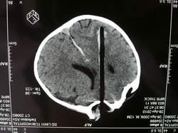 NAH: Niet Aangeboren Hersenletsel Niet- traumatisch CVA