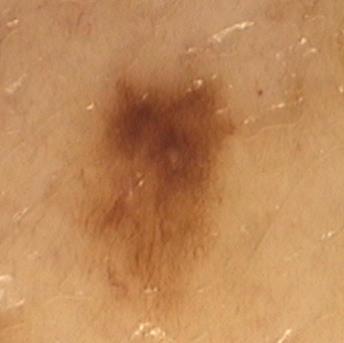 Histopathologie De 5 invasieve melanomen hadden een Breslow-dikte tussen 0,4 mm en 0,8 mm zonder ulceratie of dermale mitosen, daarmee vielen ze met een Breslow-dikte kleiner dan 1,0 mm binnen het
