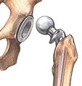 De totale heupprothese wordt daarom bij voorkeur gebruikt bij senioren die geen ernstige medische voorgeschiedenis hebben en voor de operatie nog goed te been zijn.