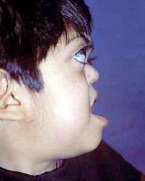 syndromale craniosynostosis - Crouzon