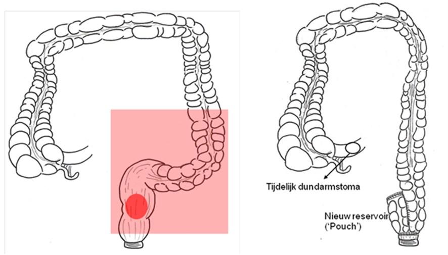 Rectumresectie met protectief loop ileostoma U ondergaat een wegname of resectie van het laatste deel van de dikdarm (de endeldarm of het rectum).