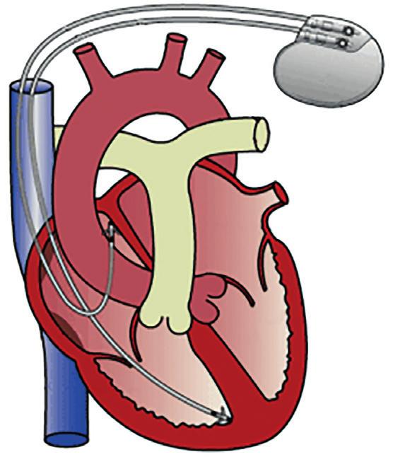 Pacemaker Een pacemaker heeft als doel de elektrische functie van het hart te ondersteunen. Een pacemaker is een elektrisch toestelletje waar de batterij een elektrische puls genereert.