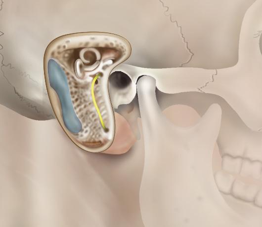 De operatie Bij een cholesteatoomoperatie wordt meestal een huidsnede achter het oor gemaakt en het bot achter de oorschelp (mastoïdholte) wordt open geboord (zie tekening).