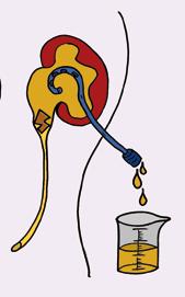 De nier staat dan al wat onder druk en extra drinken zal de pijn doen toenemen. Als een nier de urine niet meer goed kwijt kan, ontstaat stuwing. Het kan dan van belang zijn om de nier te ontlasten.