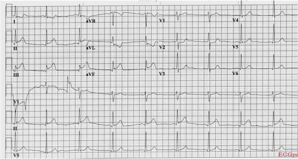 Inferior STEMI