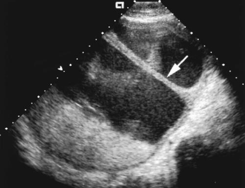 Etiologie adhesies Amniotic sheets Omvouwing van membranen om