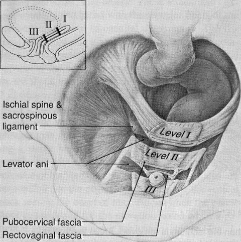 GENERAL INTRODUCTION AND OUTLINE OF THE THESIS INTRODUCTION Pelvic organ prolapse (POP) is defined as the downward displacement of one of the pelvic organs from its normal location.