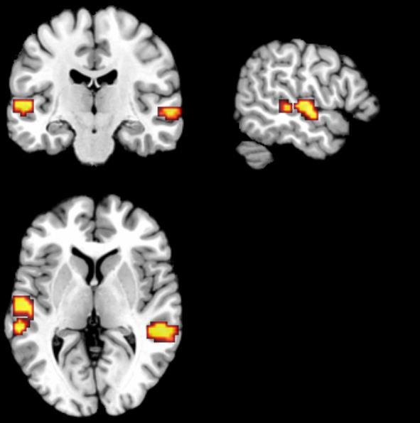 Resultaten whole-brain searchlight MVPA Hebben we anatomische regio s over het hoofd gezien die gevoelig zijn voor het fonologische contrast of die groepsverschillen in gevoeligheid herbergen?