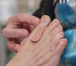 Hallux valgus conservatieve behandeling