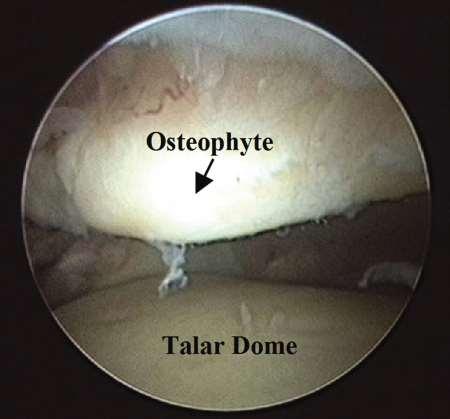 Sportletsel: voorste impingement = inklemming Artroscopie enkel Verwijderen osteofyten