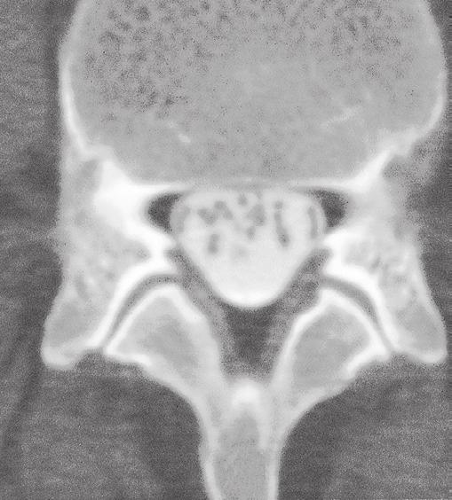 Ruggenmerg en wervelkanaal: beeldvorming 3 4.89 Axiale CT-scan (transversale doorsnede) ter hoogte van de 4e lendenwervel bij een 60-jarige vrouw.