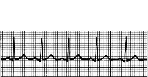 Het ECG: wat meten we? Actie potentiaal (AP) SA Knoop (Pacemaker) Atrium AV Knoop Purkinje vezels Ventrikel R Sinus ritme Oppervlakte ECG P T 1 beat Q S Het ECG: wat meten we?