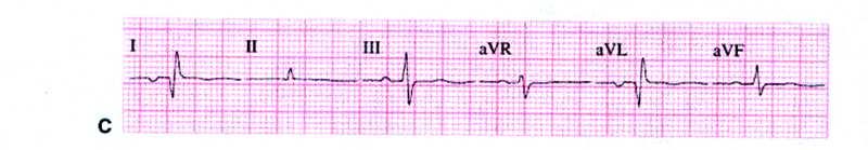 Het ECG: hoe meten we?