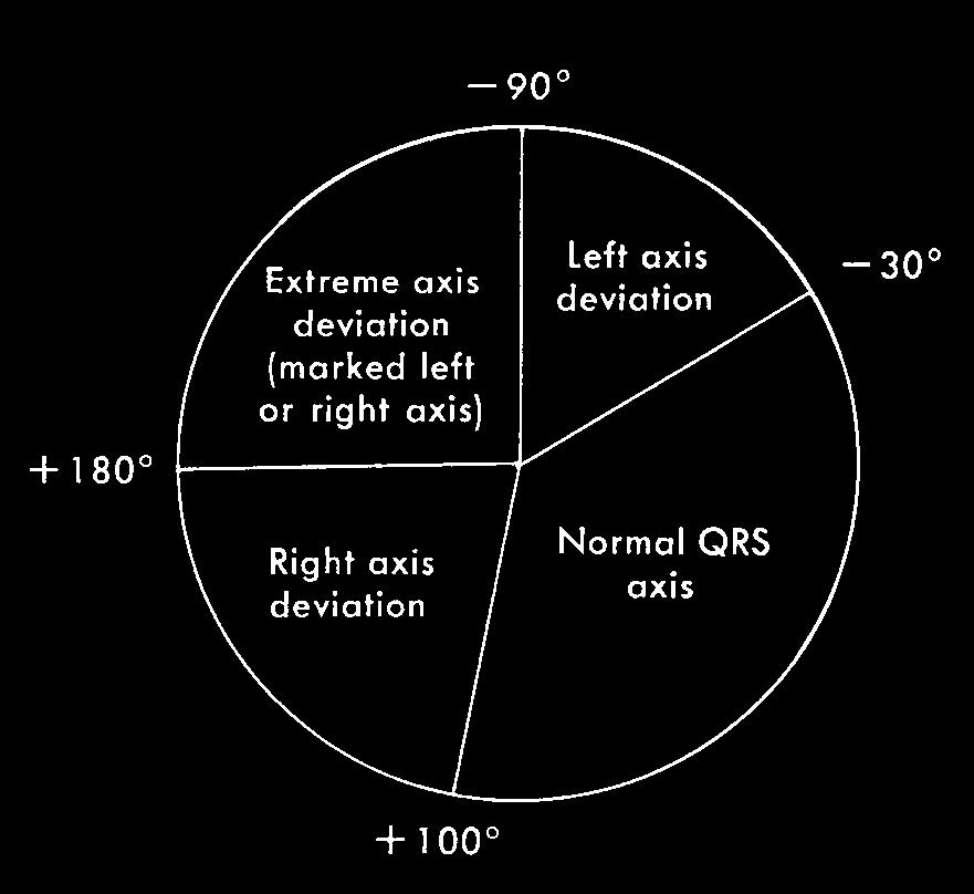 Asbepaling van het QRS Elektrische hartas = de globale richting van de kamer activatie Asbepaling van het QRS Normale QRS as De punt