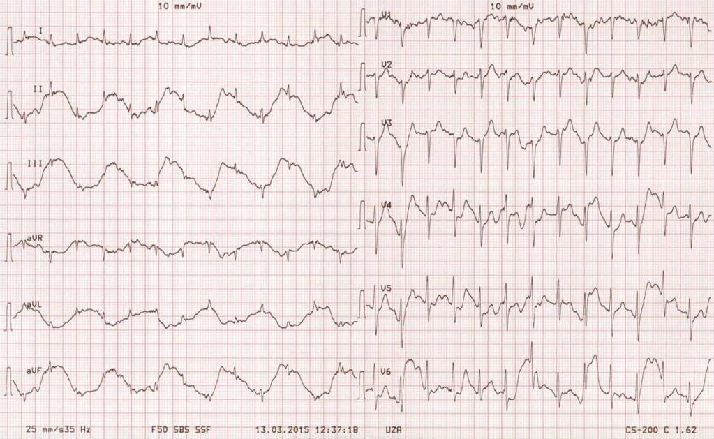 Het normale ECG in 10 stappen Stap 1: Is het ECG