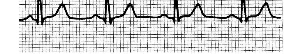 5cm of 200ms) tussen R-R interval Probleem: weinig