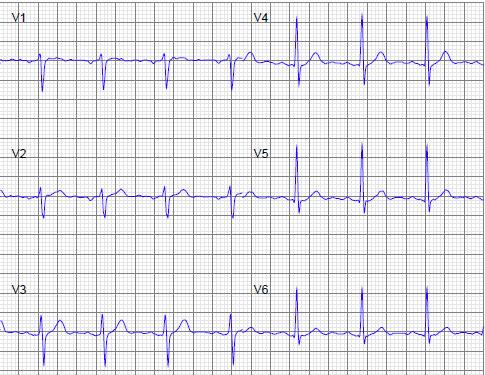 Het normale ECG in 10 stappen Stap 7: R-progressie & Transitiezone Precordiale evolutie ventrikulaire depolarisatievector Normaal: R-progressie V 1 V 4 /V 5 Transitiezone V 3 -V 4 Het normale