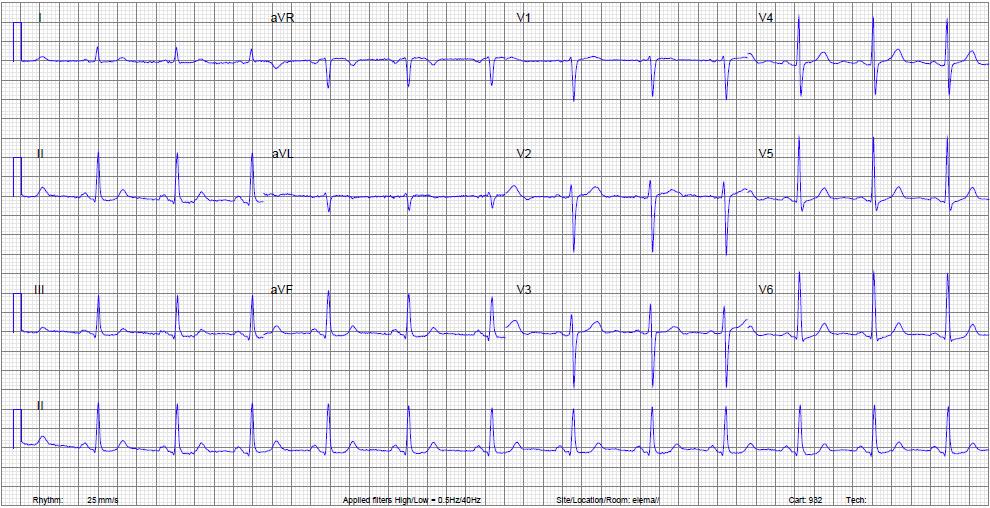 ECG 4 Oefeningen ECG Protocol Stap 1: Interpreteerbaar volledig ijking? Stap 2: Artefacten? Stap 3: Ritme: sinus regelmaat hartfrequentie?