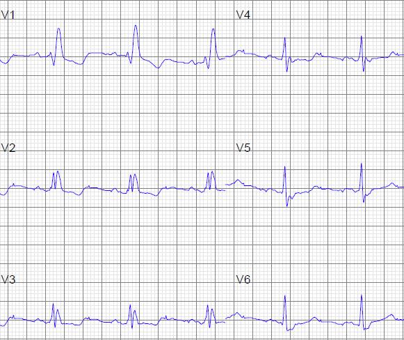 Rechter bundeltakblok (RBTB) Gevolgen voor het ECG: QRS verbreding 1/ Initiele vector naar rechts voor (= septale depolarisatie) 2/ Vector draait naar links achter (=