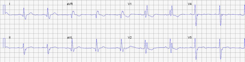 Rechter venrikel hypertrofie (RVH) Verdikking RV wand = amplitude