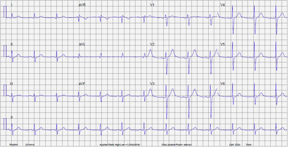 ECG Protocol Stap 1: Interpreteerbaar volledig ijking? Stap 2: Artefacten? Stap 3: Ritme: sinus regelmaat hartfrequentie?