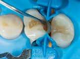 Dit wordt stap voor stap toegepast in de vervaardiging van tandklasse IV.