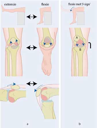 In de praktijk low res Figuur 8. De apprehensiontest van de patella. Bij een gestrekte knie beweegt de onderzoeker de patella naar lateraal. De test is positief bij reflexmatige contractie van de m.