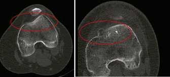 Figuur 9. Een CT-scan van een patiënt met een normale trochlea links en een dysplastische trochlea rechts.