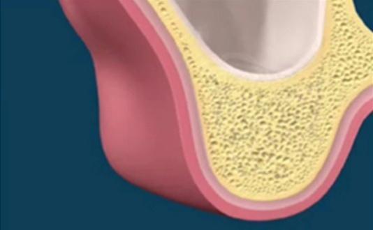 Daarnaast kunnen de neusbijholten in de geslonken bovenkaak voor problemen zorgen: de bothoogte van de bovenkaak is onvoldoende om de implantaten te kunnen plaatsen.