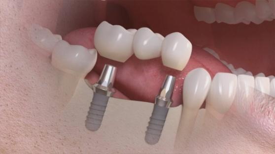 Hoe gaat de behandeling verder? Het aangebrachte implantaat wordt meestal verstopt onder het tandvlees, zodat het rustig kan vastgroeien.