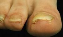 Dia 10 Hypertrofische nagels Plaatselijk verdikte nagel Hyperkeratosis subunguinalis Onychomycosis Onychochauxis