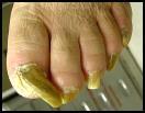 13 Dia 14 Hoornnagel / onychauxis Algeheel regelmatig verdikte nagelplaat Ligt in de nagelmatrix Kan door trauma komen Ouderdom Krappe schoenen.