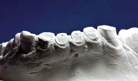 tandtechniek - door Paul Goedegebuure, tandtechnicus De visie van een tandtechnicus Behandeling van excessieve gebitsslijtage Gebitsslijtage door