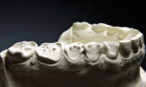 Of dat nu, zoals voorheen, met kroon- en brugwerk in goud/porselein gedaan wordt of met composiet, maakt voor de gnathologische functie an sich niet uit.