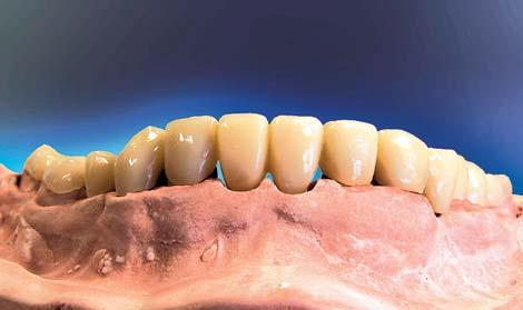 Tandtechnicus of tandarts kan bij het monteren in de articulator uitgaan van maximale occlusie.