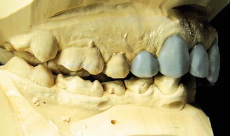 Beetverhoging Vervolgens wast de tandtechnicus de twee centrale onderincisieven op, puur op gevoel voor vormgeving en anatomische verhoudingen.