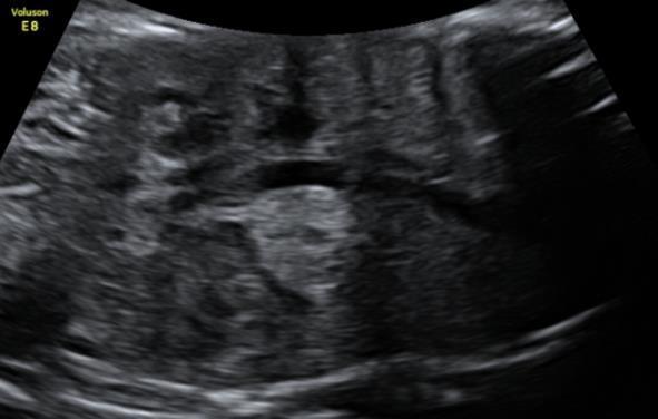 trimester massa intra abdominaal achter linker nier Verwijzing GUO
