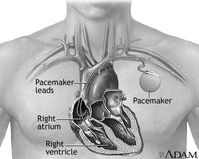 1 Inleiding Het hart is uitgerust met een soort elektrisch startsysteem dat vele malen per minuut de hartspier een prikkel geeft om samen te trekken.