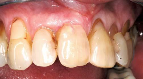restauratieve tandheelkunde - door dr. A. van Dalen, tandarts Verlies van 11. Wat dan? * Een 60-jarige dame meldt zich op de polikliniek voor Orale Diagnostiek van ACTA.