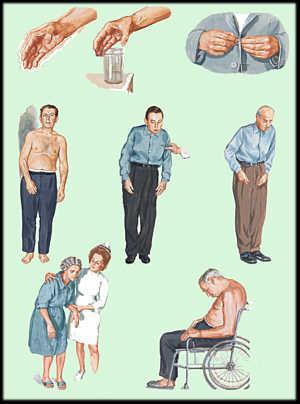 Symptomen bij Parkinson Veel voorkomende symptomen: Tremor (handen, benen, kin of tong); > in rust, geldtel tremor Bradykinesie (trager worden van bewegingen) Akinesie (moeite met starten van