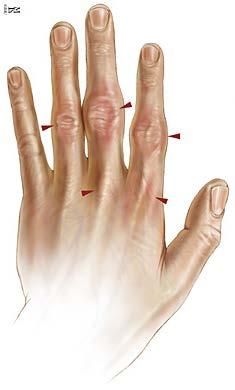 Gewrichtspijn ontstaat vooral in de vingers, waarbij geen visuele afwijkingen te zien zijn en geen