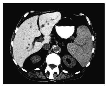 17 In figuur 20 is een CT-scan van een lever vol met ijzer te zien. De lever moet normaal dezelfde kleur hebben als de milt!