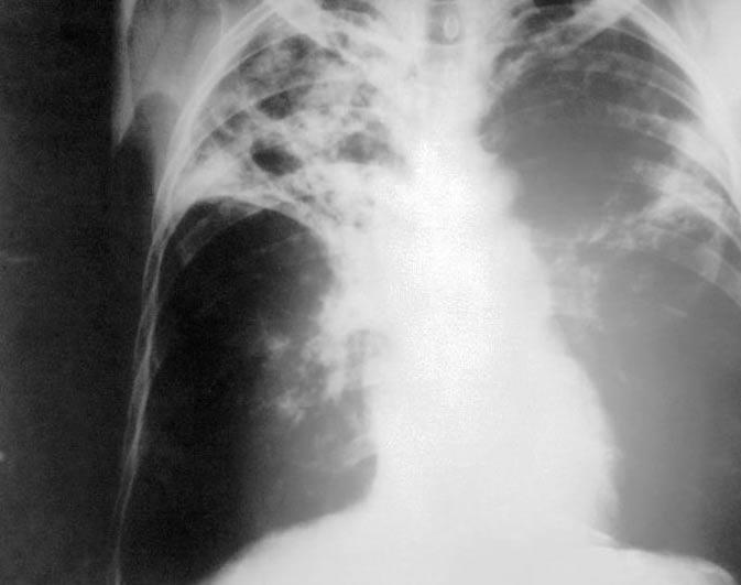 Tuberculose in Vlaanderen 2002 Inleiding Tuberculose is nog steeds een van de belangrijkste en meest frequent voorkomende geregistreerde infectieziektes.