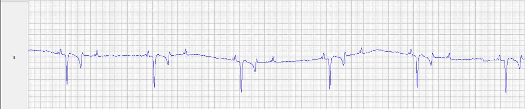 Op het ecg in rust werden afwisselend periodes van totale 3 e graad atrioventriculaire blok gezien (afbeelding 6 boven). Deze waren frequent geassocieerd met een syncope.