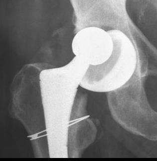 fractuur - Implantfalen =