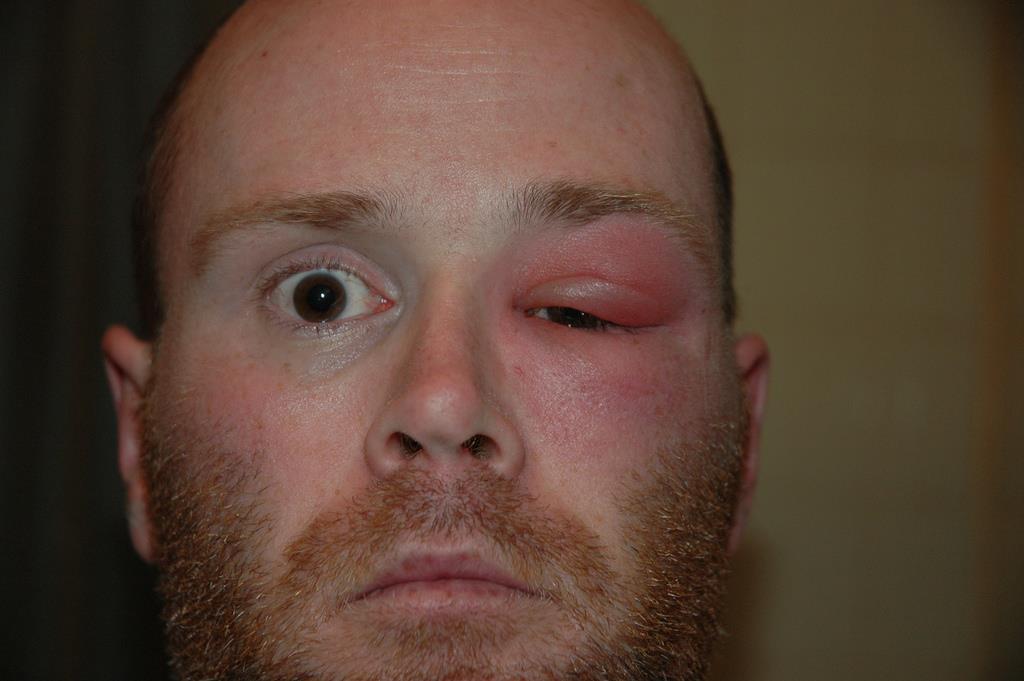 Roodheid 32-jarige man unilateraal gezwollen, rood ooglid moeilijke visus wegens