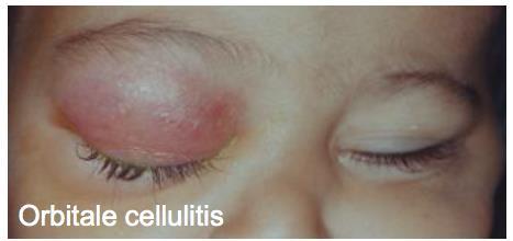 Cellulitis preseptaal vs orbitaal Preseptaal vaak vanuit huidwonde Geen algemene symptomen Antibiotica per os (flucloxacilline of