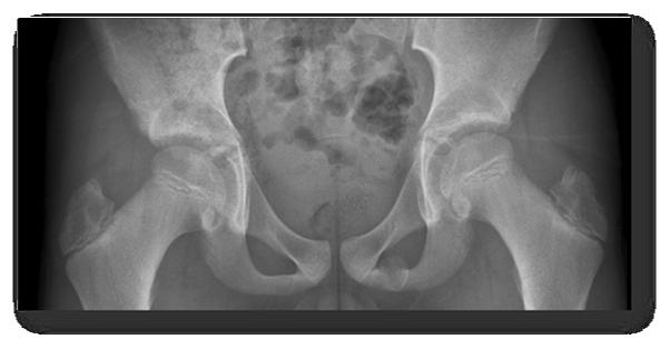 11/12/2018 Ischiopubische tak synchondrose Adductor-like klachten < 13-14 jaar Vaak