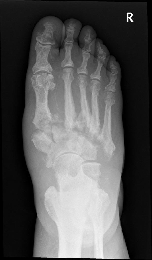 Charcot-voet dus bij twijfel altijd een Röntgenfoto Drie valkuilen bij Diabetische Keto-Acidose Hyperglykemie 1.